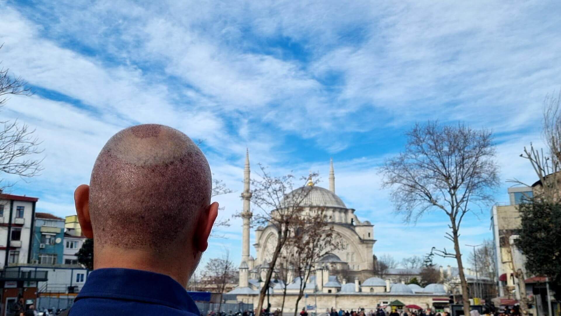 Hair Transplant Turkey
