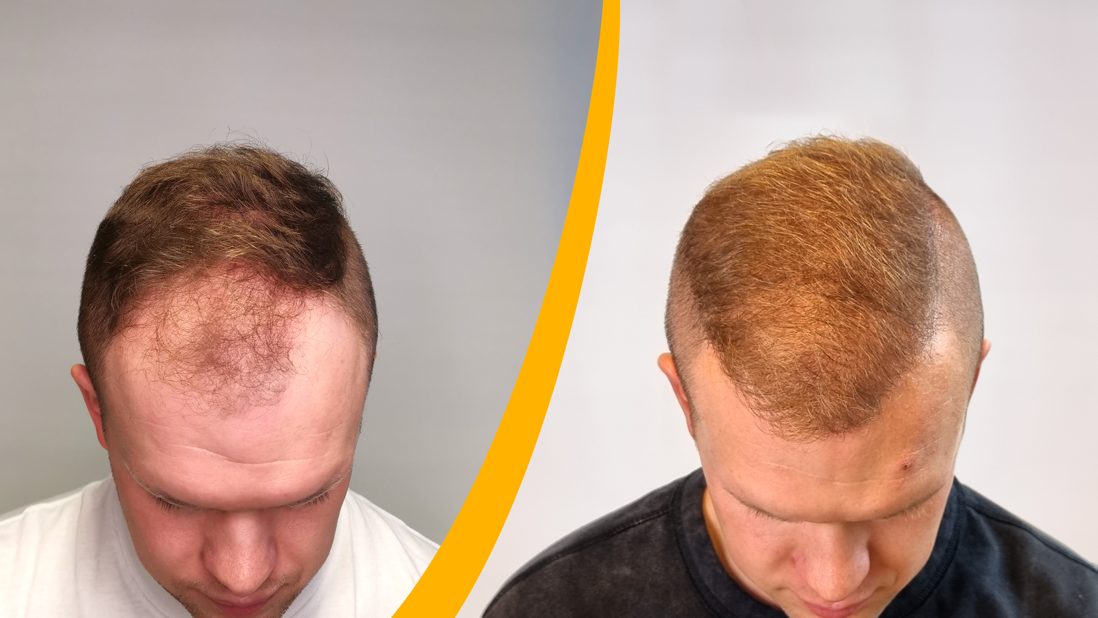 Før-Efter - Hårtransplantation resultat Før-Efter - Hårtransplantation resultat