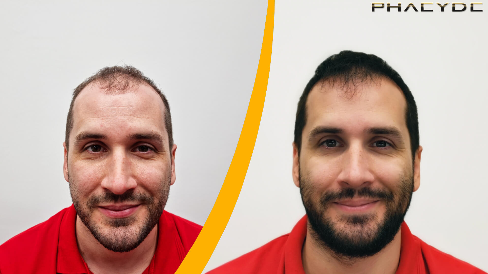Resultater Før og Efter Hårtransplantation Resultater Før og Efter Hårtransplantation