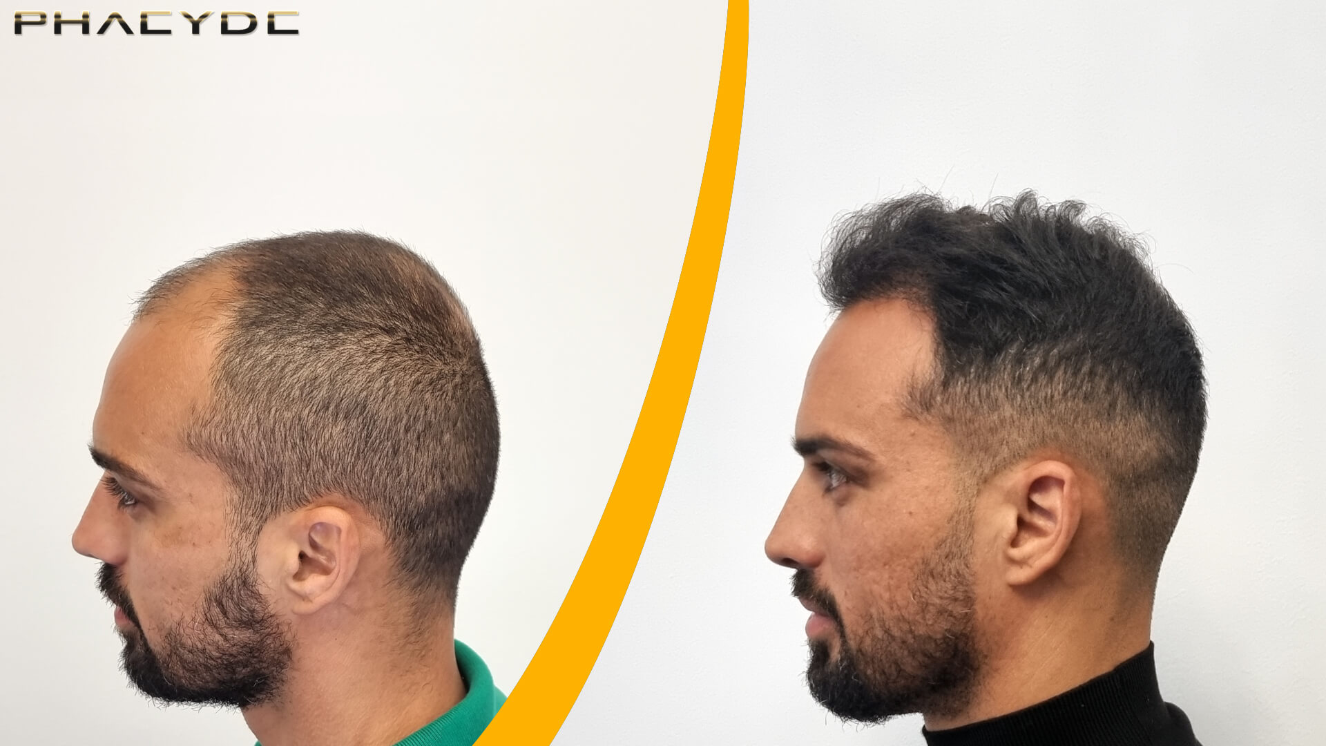 Hårtransplantation - Før & Efter Resultat Hårtransplantation - Før & Efter Resultat