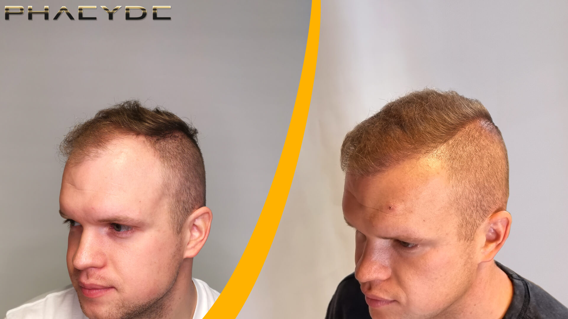 Patrik: Før-Efter Hårtransplantation Patrik: Før-Efter Hårtransplantation