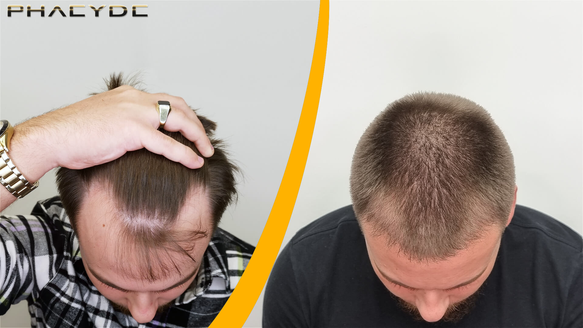 Før- og efterbillede af en hårtransplantation