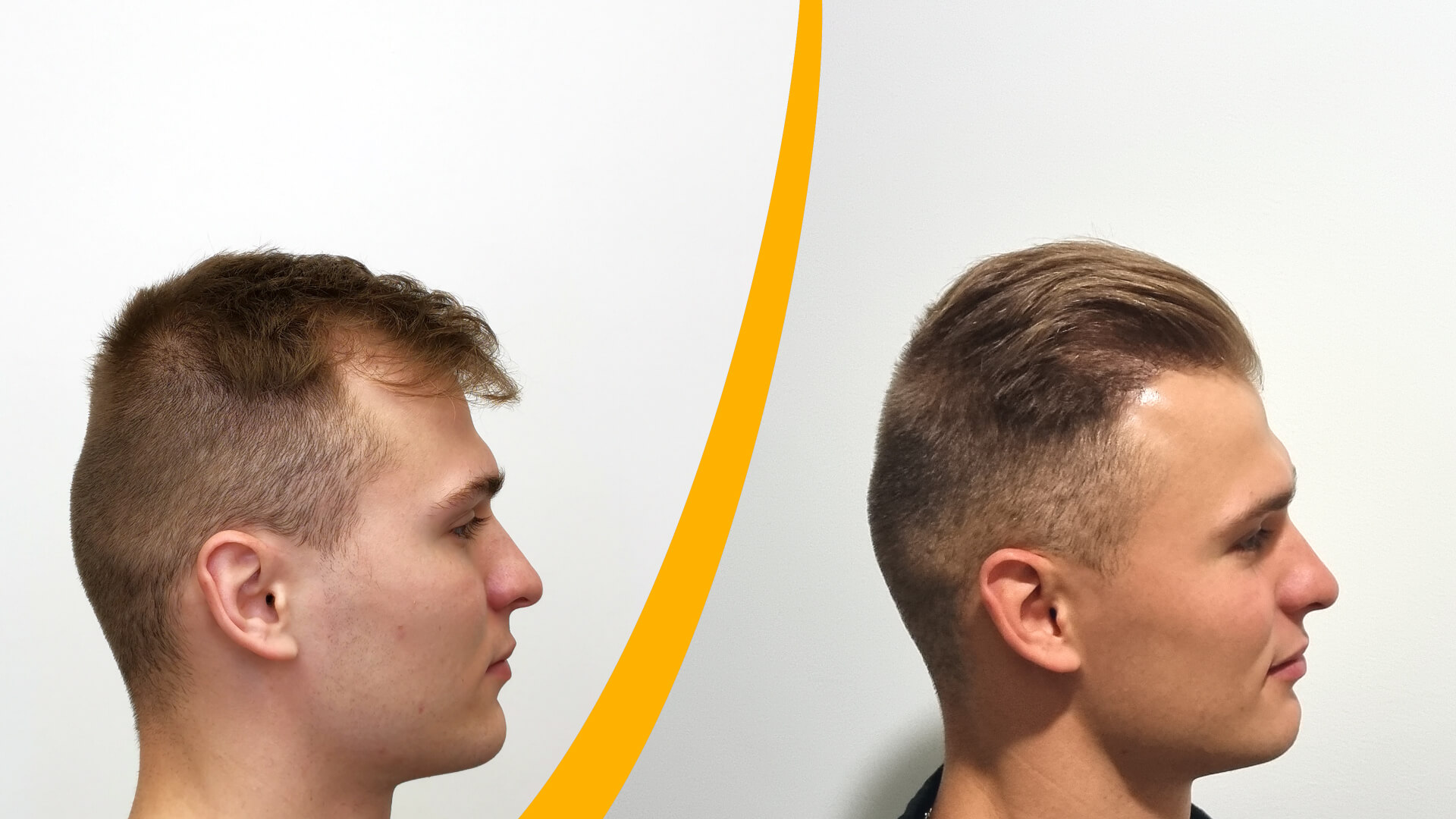 Hårtransplantation - Før & Efter Resultat Hårtransplantation - Før & Efter Resultat