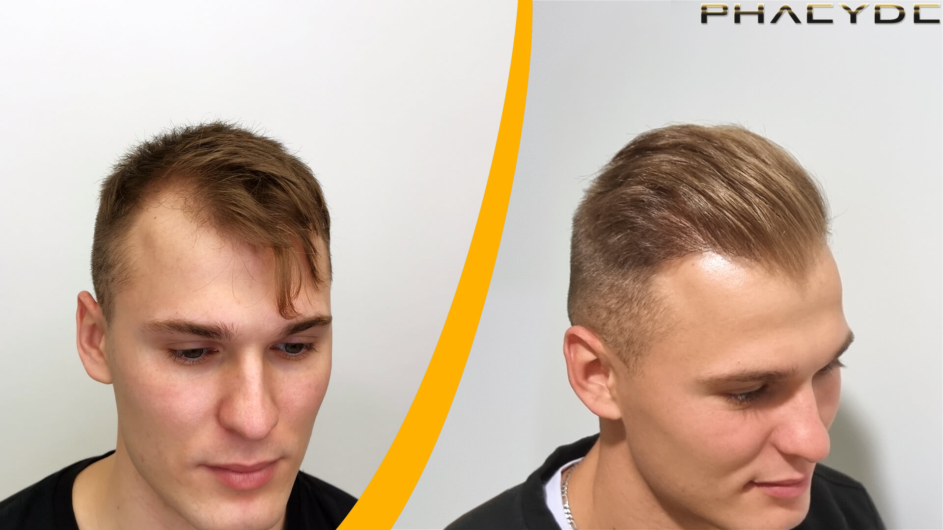 Resultater Før og Efter Hårtransplantation Resultater Før og Efter Hårtransplantation