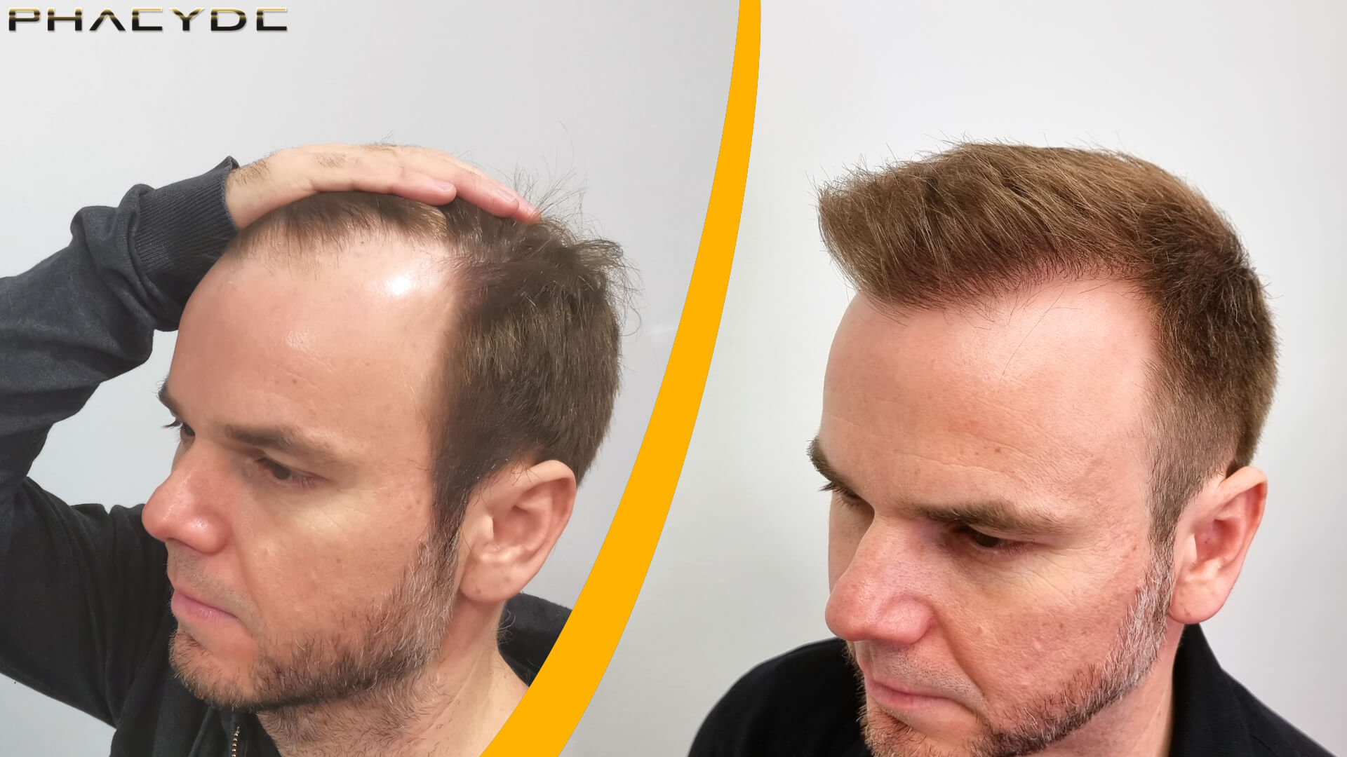 Hårtransplantation - Før & Efter Resultat Hårtransplantation - Før & Efter Resultat
