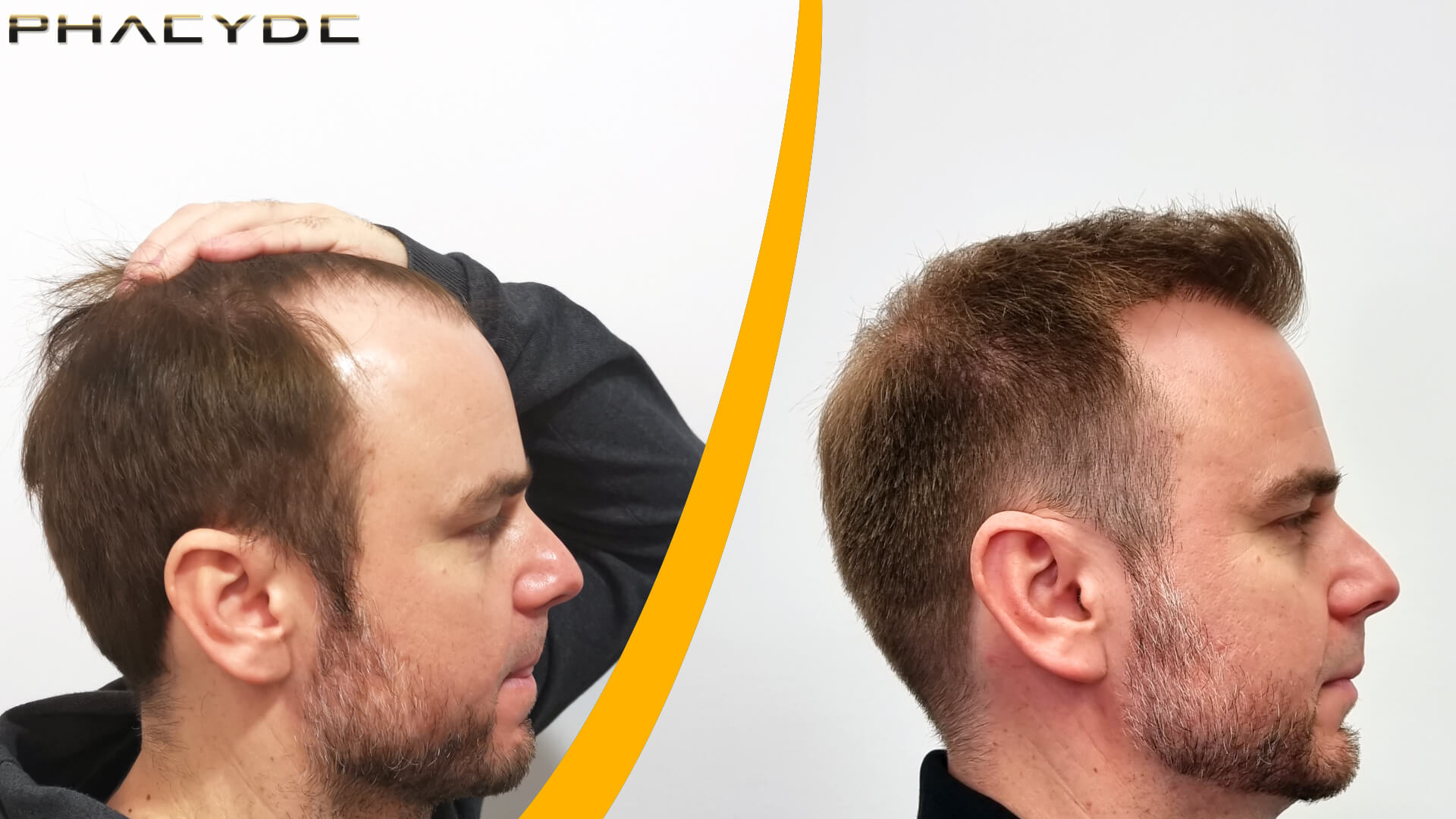 Før og efter en hårtransplantation