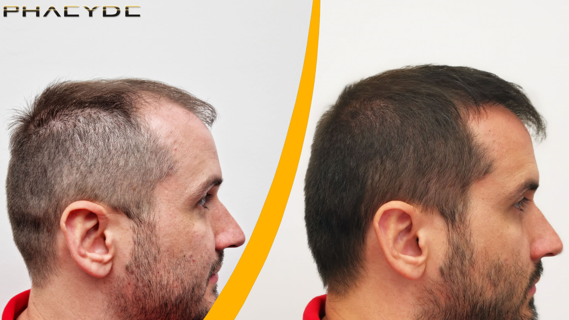 Før og efter en hårtransplantation Før og efter en hårtransplantation