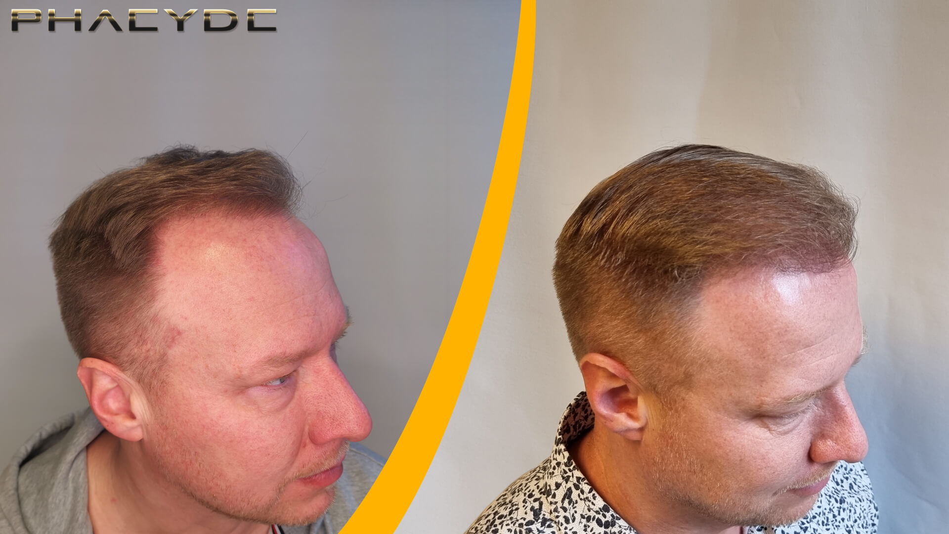 Før og Efter Hårtransplantation - 1600 Grafts Før og Efter Hårtransplantation - 1600 Grafts