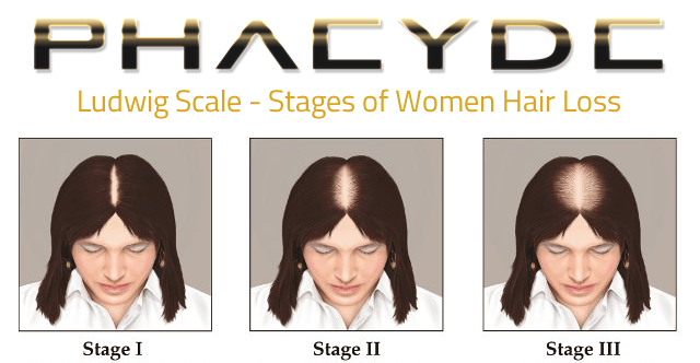 hair-transplant-for-woman
